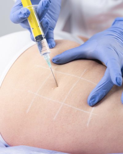 Intradérmoterapia